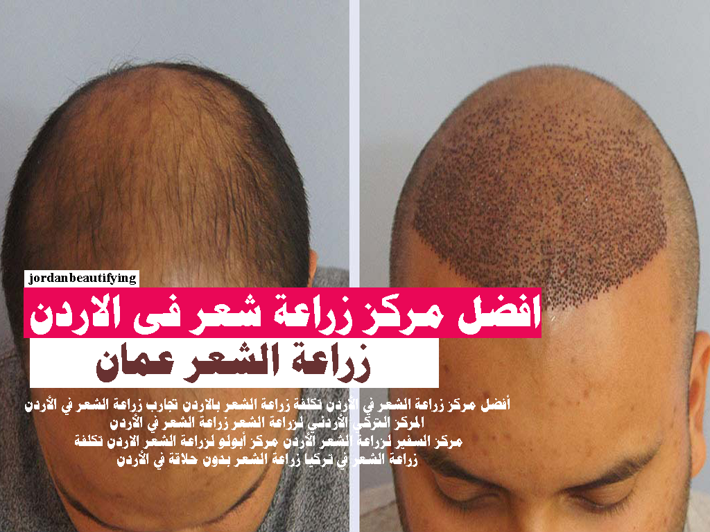 زراعة الشعر عمان أفضل مركز زراعة الشعر في الأردن