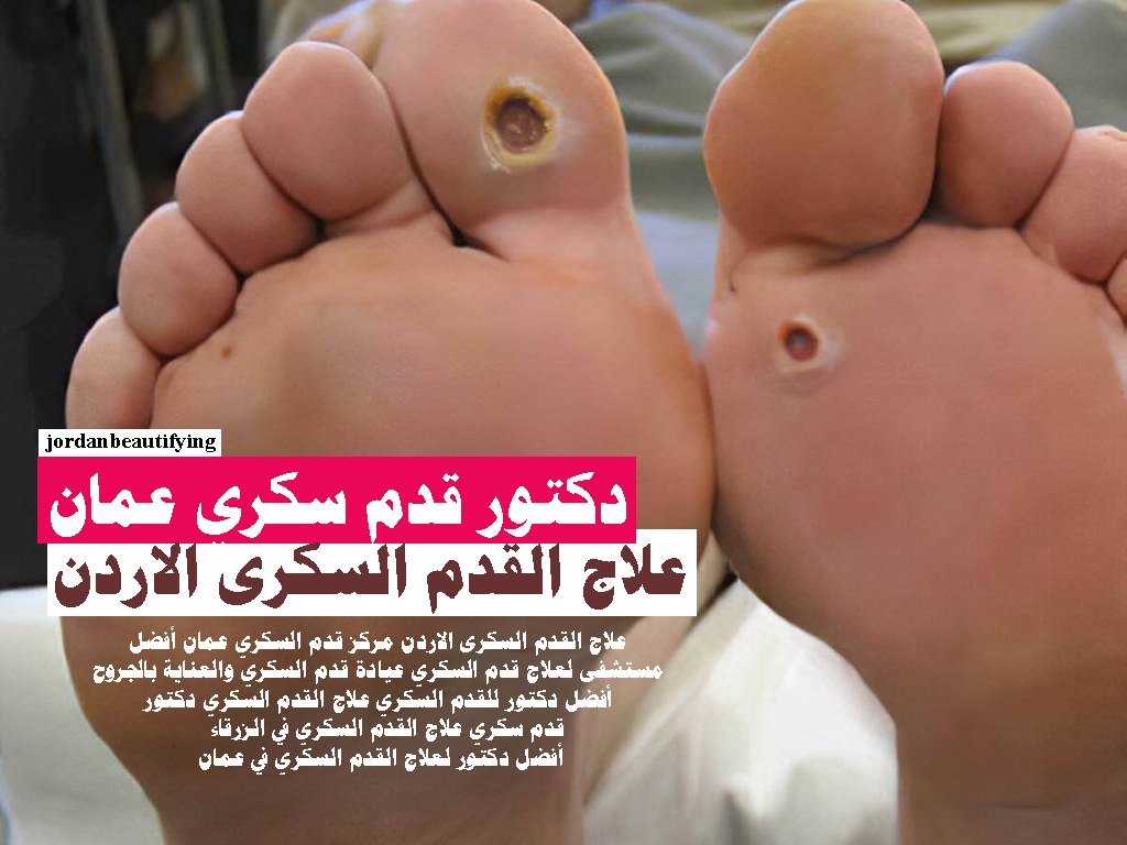 علاج القدم السكرى الاردن دكتور قدم سكري عمان